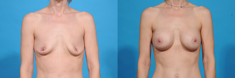 Breast Augmentation