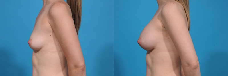 Breast Augmentation