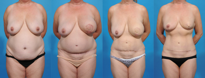 Aesthetic_Specialists_3-DIEP-Breast-Reconstruction