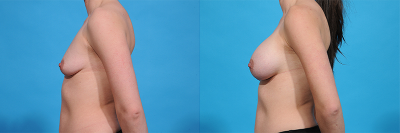 Breast Augmentation