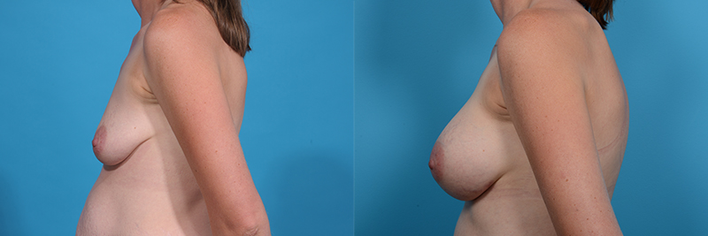 Breast Augmentation