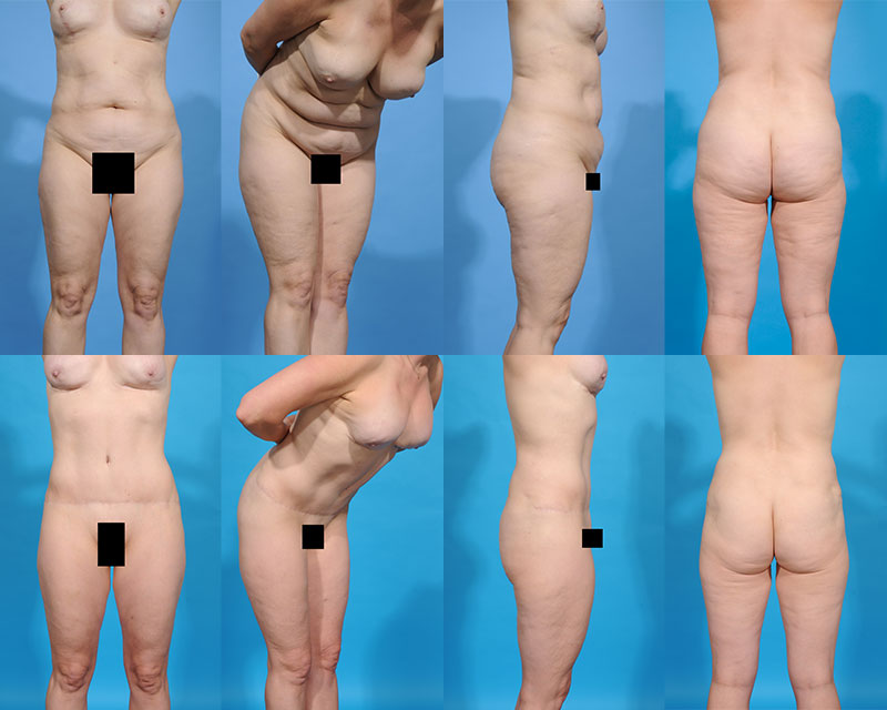 Aesthetic_Specialists_Lipo_1